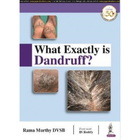 What Exactly is Dandruff?