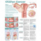 Understanding Ovarian Cancer Anatomical Chart