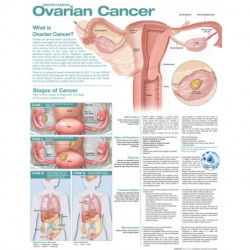 Understanding Ovarian Cancer Anatomical Chart