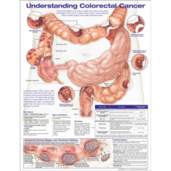 Understanding Colorectal  Cancer Anatomical Chart