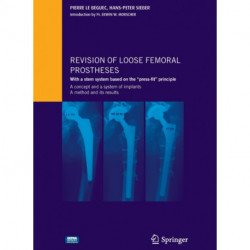 Revision of loose femoral prostheses with a stem system based on the "press-fit" principle: A concept and its system of implants, a method and its results