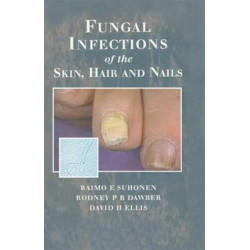 Fungal Infections of the Skin and Nails