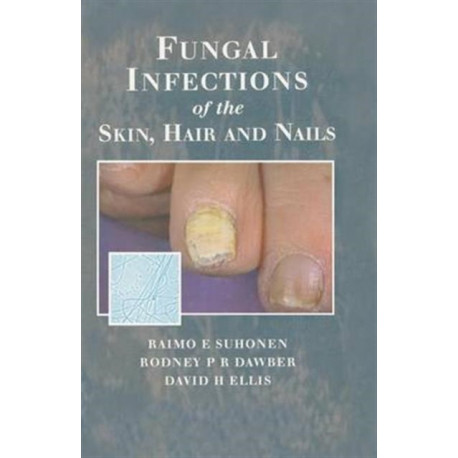 Fungal Infections of the Skin and Nails