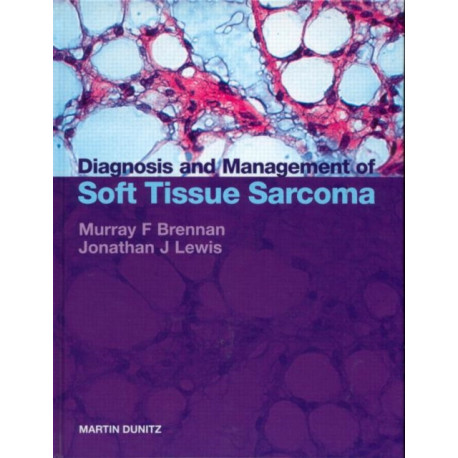 Diagnosis and Management of Soft Tissue Sarcoma