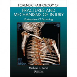 Forensic Pathology of Fractures and Mechanisms of Injury: Postmortem CT Scanning