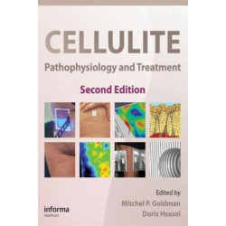 Cellulite: Pathophysiology and Treatment