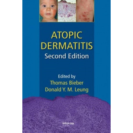 Atopic Dermatitis