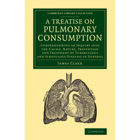 A Treatise on Pulmonary Consumption: Comprehending an Inquiry into the Causes, Nature, Prevention and Treatment of Tuberculous and Scrofulous Diseases in General