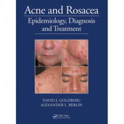 Acne and Rosacea: Epidemiology, Diagnosis and Treatment