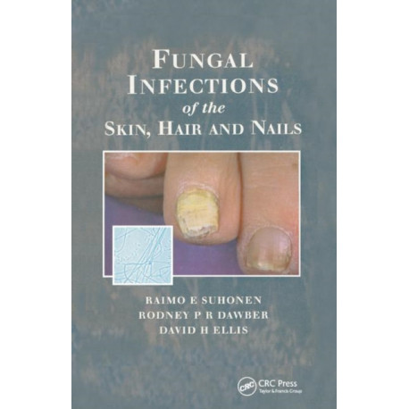 Fungal Infections of the Skin and Nails