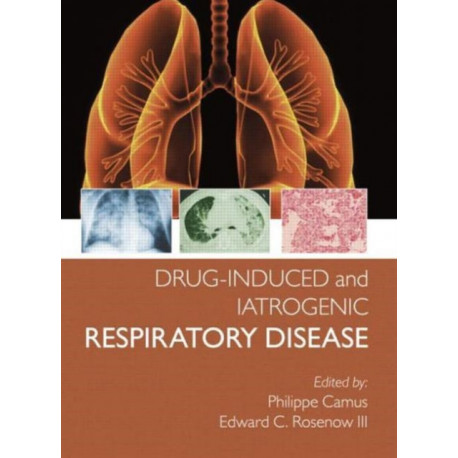 Drug-induced and Iatrogenic Respiratory Disease