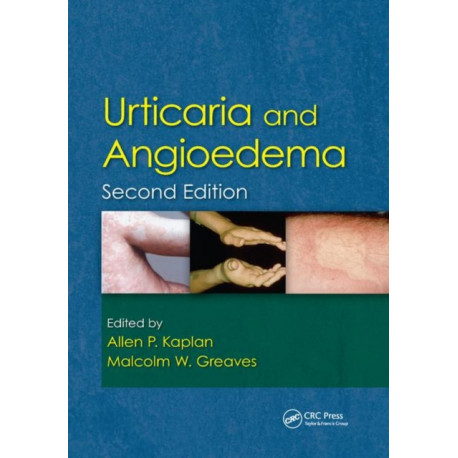 Urticaria and Angioedema