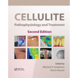 Cellulite: Pathophysiology and Treatment