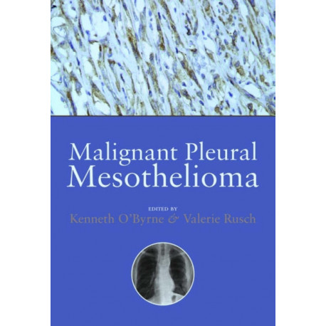 Malignant Pleural Mesothelioma