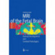 MRI of the Fetal Brain: Normal Development and Cerebral Pathologies