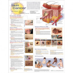 Understanding Skin Cancer Anatomical Chart