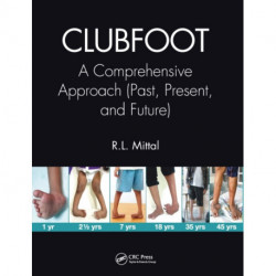 Clubfoot: A Comprehensive Approach (Past, Present, and Future)