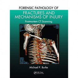 Forensic Pathology of Fractures and Mechanisms of Injury: Postmortem CT Scanning