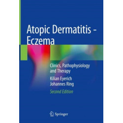 Atopic Dermatitis - Eczema: Clinics, Pathophysiology and Therapy
