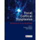Focal Cortical Dysplasias: New advances for curing epilepsy