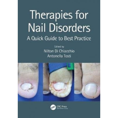 Therapies for Nail Disorders: A Quick Guide to Best Practice