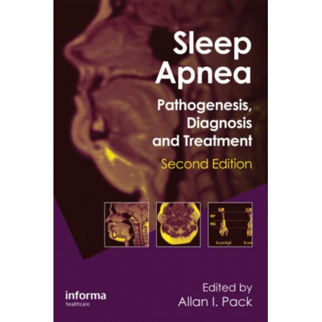 Sleep Apnea: Pathogenesis, Diagnosis and Treatment
