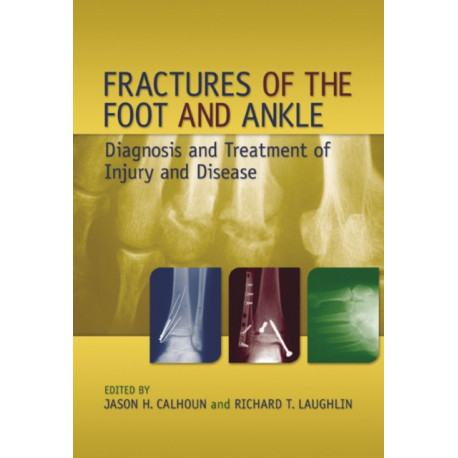 Fractures of the Foot and Ankle: Diagnosis and Treatment of Injury and Disease