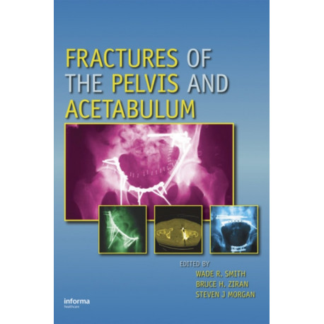 Fractures of the Pelvis and Acetabulum