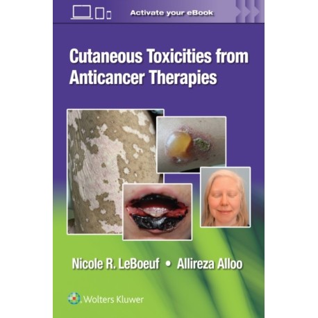 Cutaneous Toxicities from Anticancer Therapies