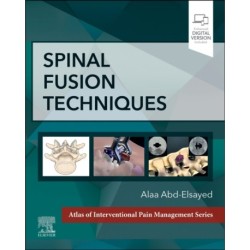 Spinal Fusion Techniques