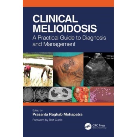Clinical Melioidosis: A Practical Guide to Diagnosis and Management