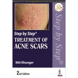 Step by Step Treatment of Acne Scars