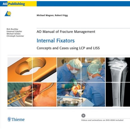 AO Manual of Fracture Management: Internal Fixators: Concepts and Cases Using LCP/LISS