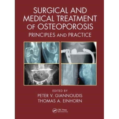 Surgical and Medical Treatment of Osteoporosis: Principles and Practice