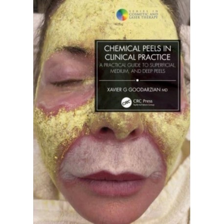 Chemical Peels in Clinical Practice: A Practical Guide to Superficial, Medium, and Deep Peels