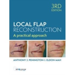 Local Flap Reconstruction