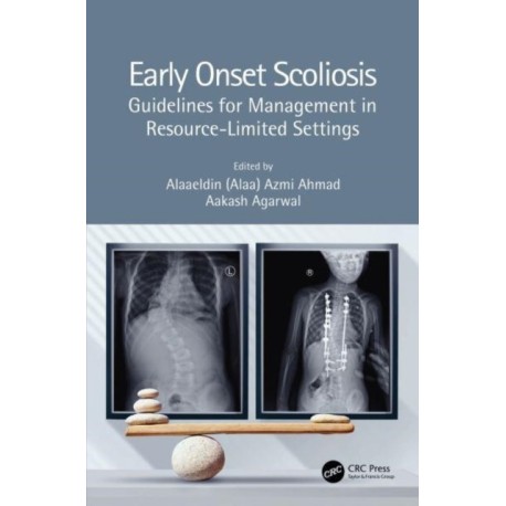 Early Onset Scoliosis: Guidelines for Management in Resource-Limited Settings