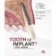 Tooth or Implant
