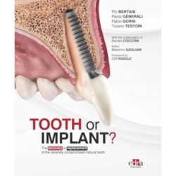 Tooth or Implant