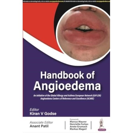 Handbook of Angioedema