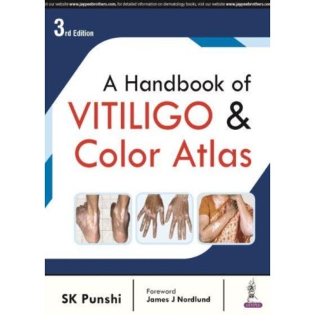 A Handbook of Vitiligo & Color Atlas