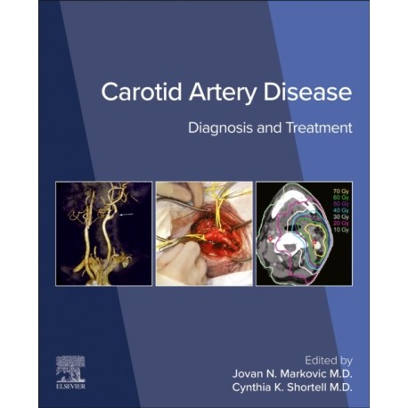 Carotid Artery Disease: Diagnosis and Treatment