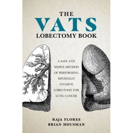 The VATS Lobectomy Book: A Safe and Simple Method of Performing Minimally Invasive Lobectomy for Lung Cancer