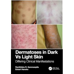 Dermatoses in Dark Vs Light Skin: Differing Clinical Manifestations