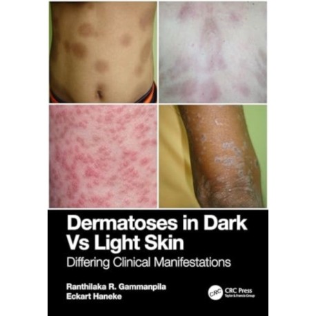 Dermatoses in Dark Vs Light Skin: Differing Clinical Manifestations
