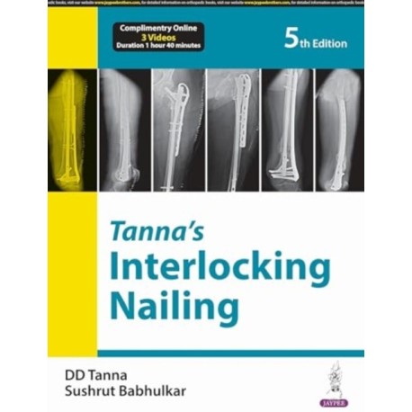Tanna’s Interlocking Nailing