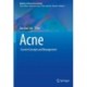 Acne: Current Concepts and Management