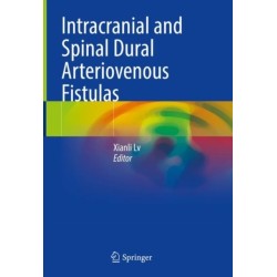Intracranial and Spinal Dural Arteriovenous Fistulas