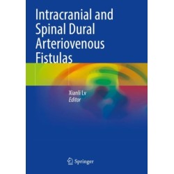 Intracranial and Spinal Dural Arteriovenous Fistulas