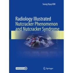 Radiology Illustrated: Nutcracker Phenomenon and Nutcracker Syndrome